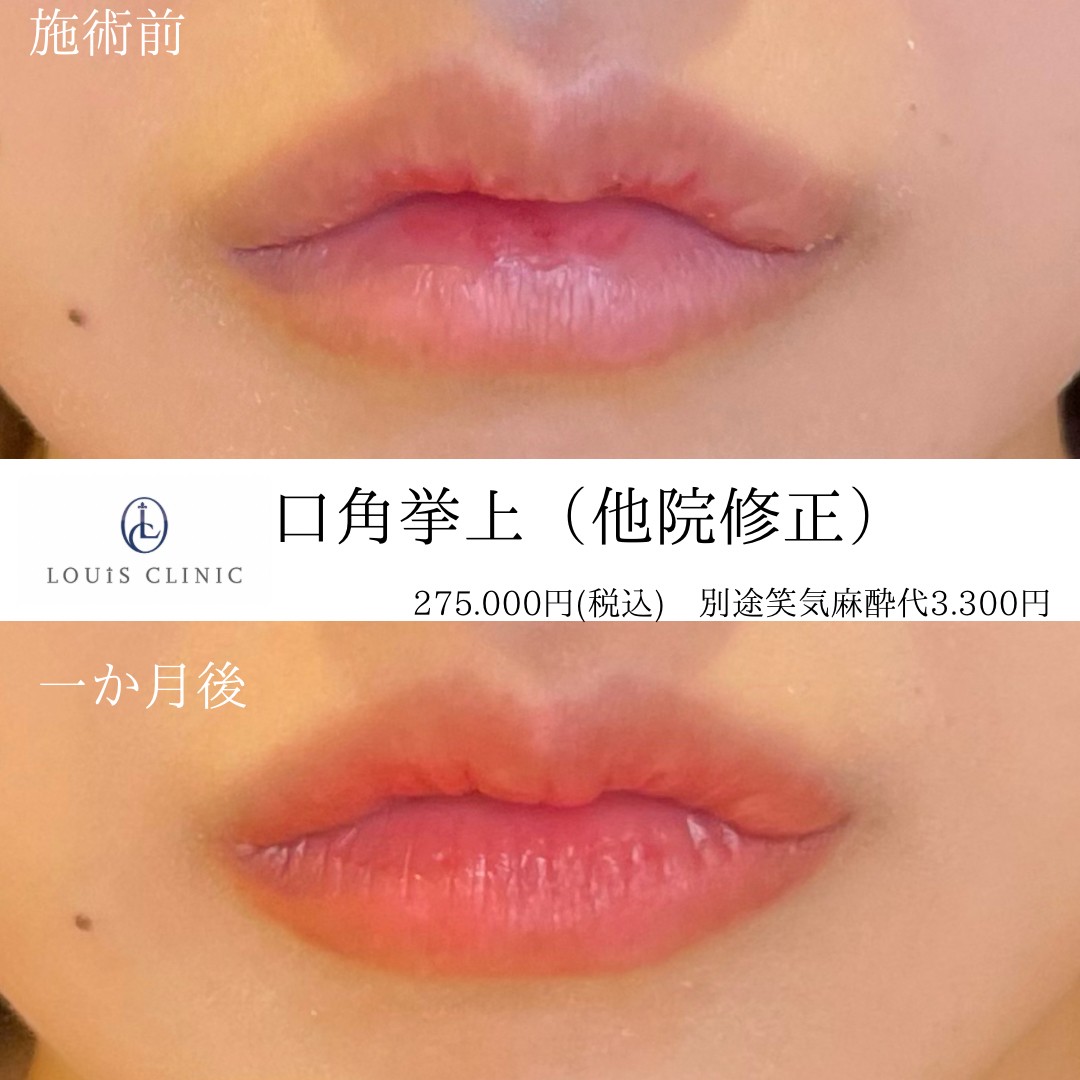 【症例写真】口角挙上 | LOUIS CLINIC/二子玉川